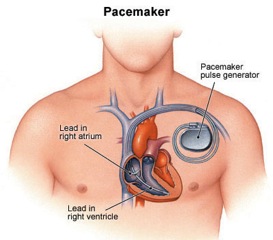Pacemaker Analysis
